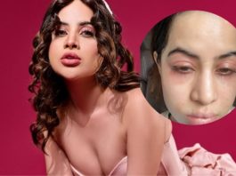 Uorfi Javed Face Allergy : These pictures of Urfi Javed are shocking, told what terrible problem the actress is going through