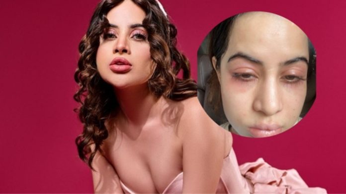 Uorfi Javed Face Allergy : These pictures of Urfi Javed are shocking, told what terrible problem the actress is going through